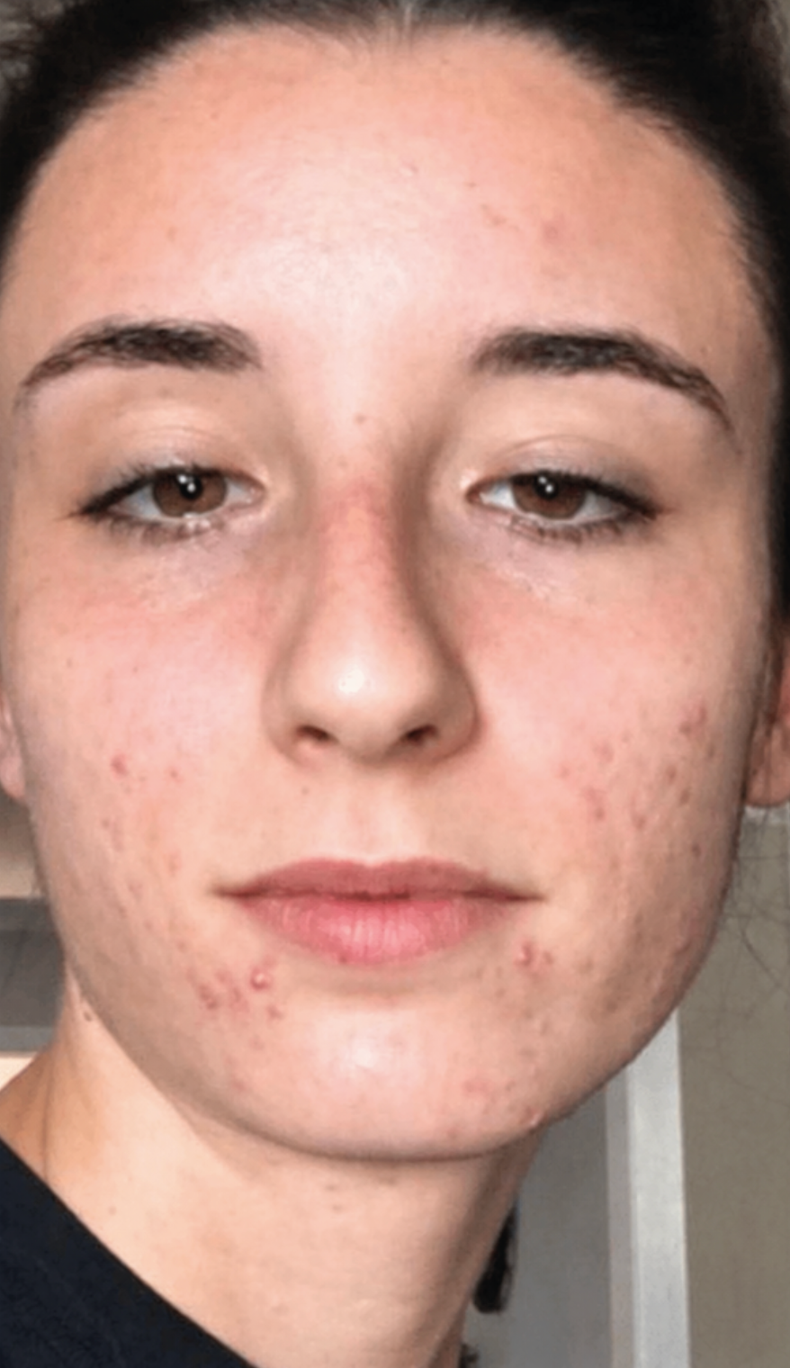 Carey esthétique