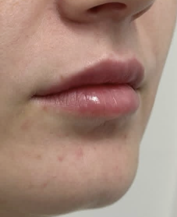 Carey esthétique